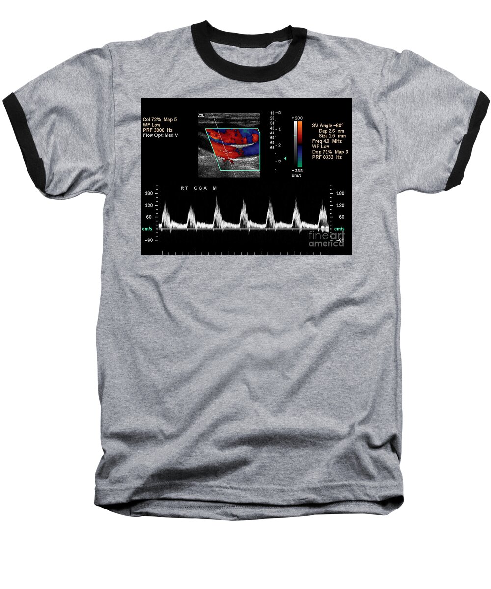 Carotid Artery Baseball T-Shirt featuring the photograph Carotid Duplex Ultrasound Exam #4 by Living Art Enterprises LLC