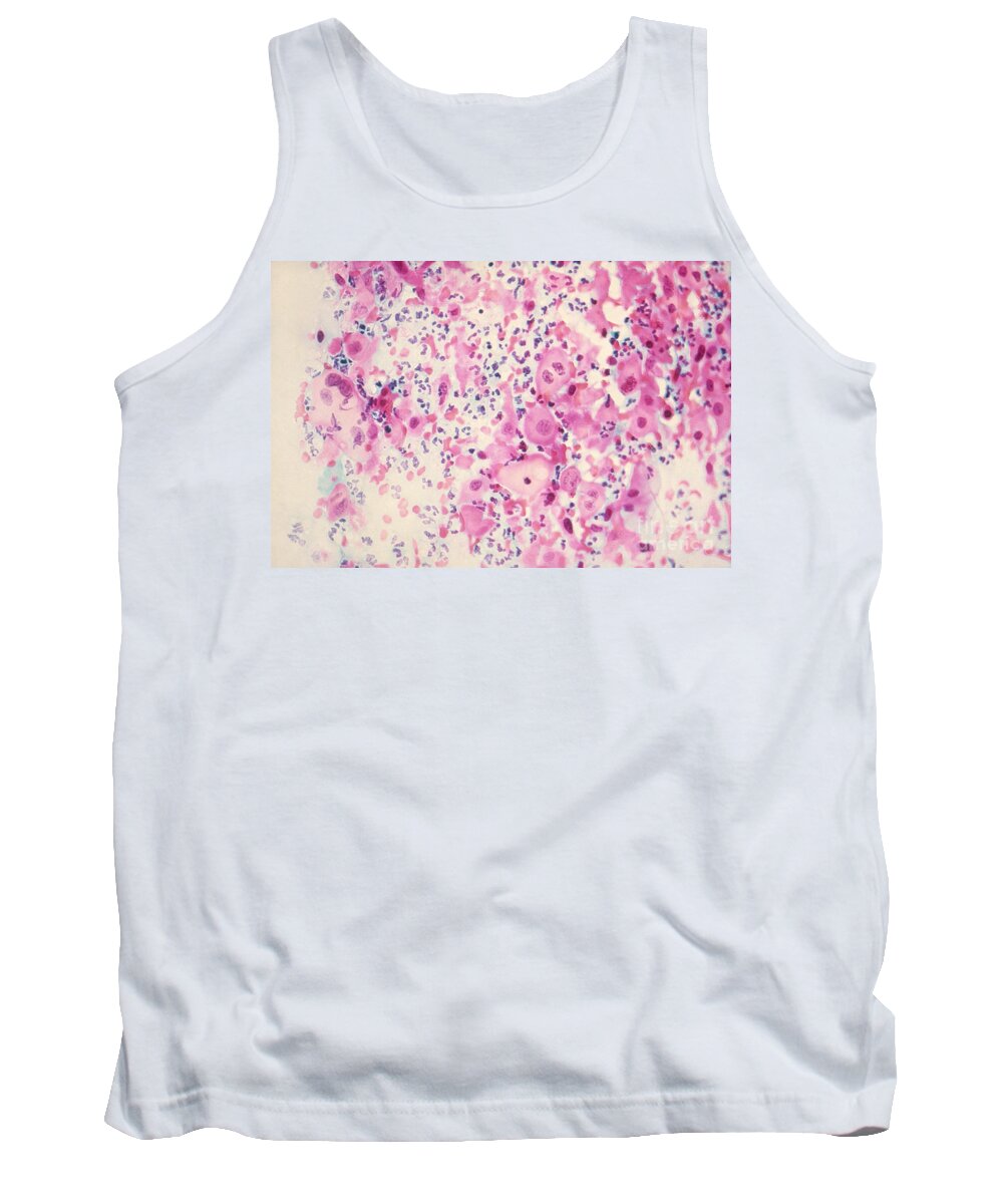 Medical Tank Top featuring the photograph Pap Smear Cancer #3 by Science Source