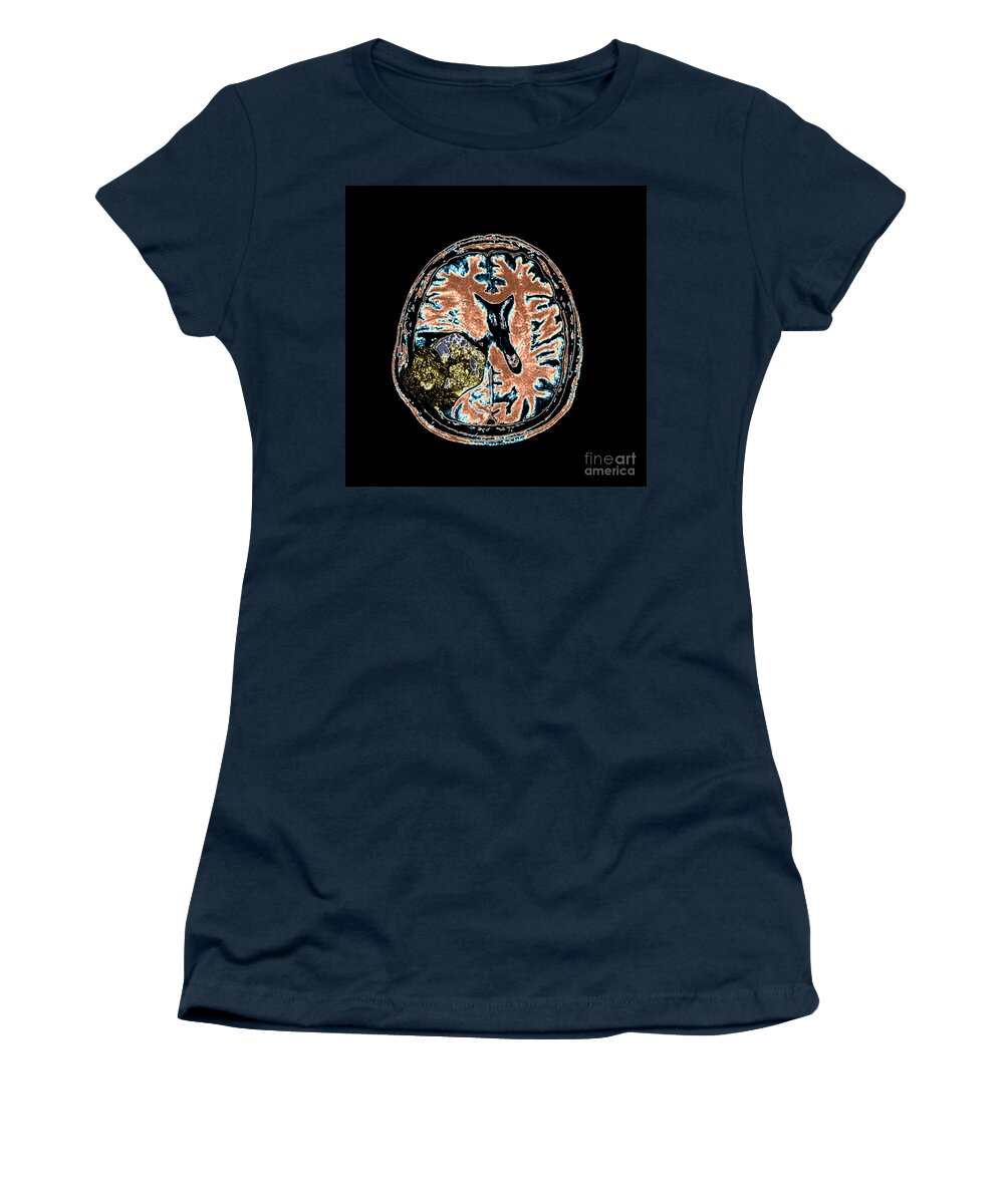 Mri Women's T-Shirt featuring the photograph Mr Of Malignant Brain Tumor 2 Of 3 by Living Art Enterprises
