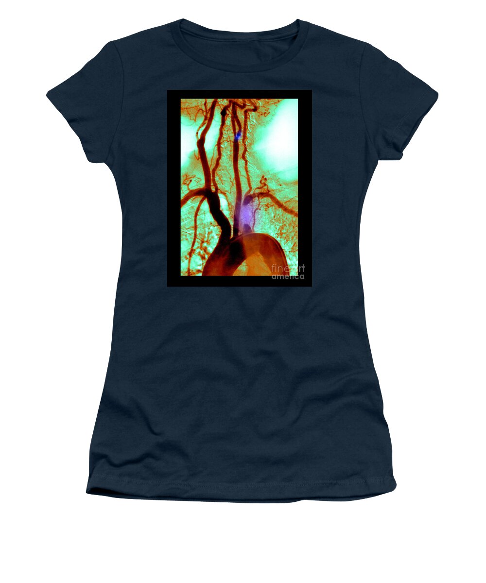 Abnormal Angiogram Women's T-Shirt featuring the photograph Aortic Arch Angiogram #1 by Medical Body Scans