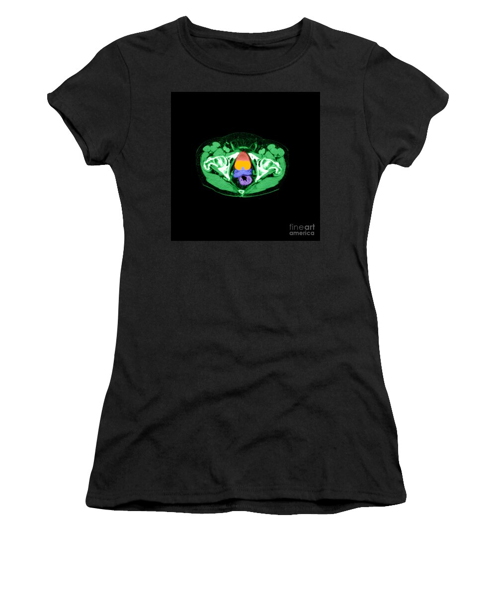 Bladder Women's T-Shirt featuring the photograph Ct Of Enlarged Prostate #1 by Medical Body Scans