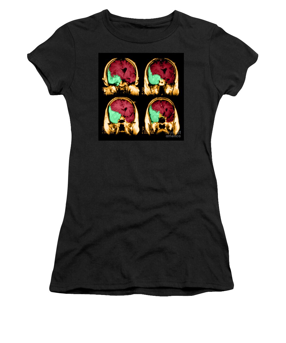 Image Of Invasive Meningioma Women's T-Shirt featuring the photograph Meningioma #1 by Medical Body Scans