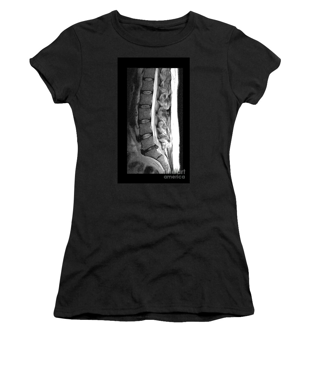 Mri Women's T-Shirt featuring the photograph Herniated Disc by Medical Body Scans