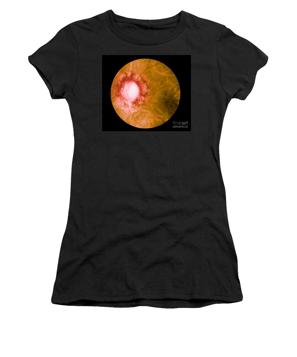 Bacteria Women's T-Shirt featuring the photograph Retina Infected By Syphilis by Science Source