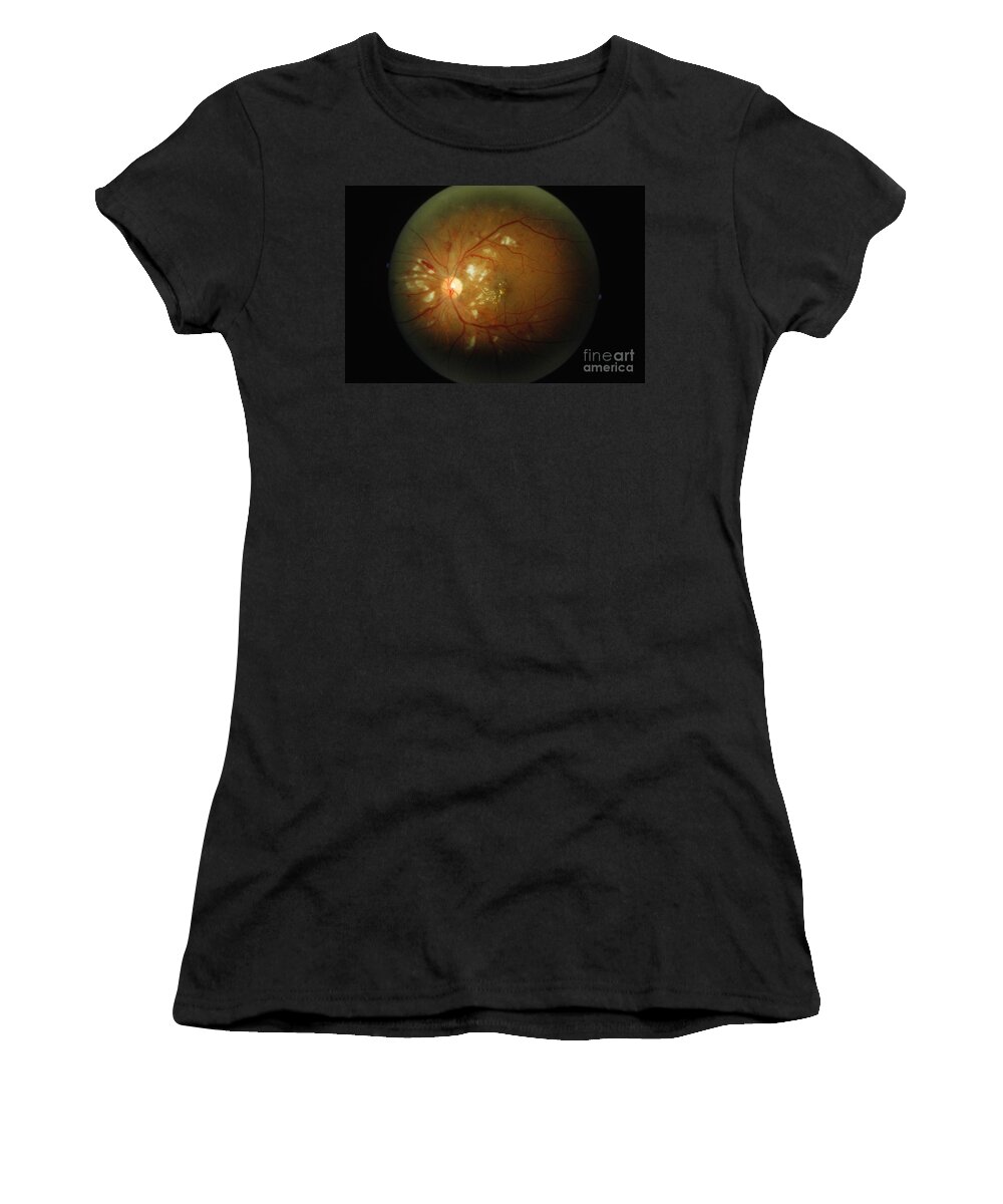 Blood Vessels Women's T-Shirt featuring the photograph Cmv Retinitis #1 by Science Source