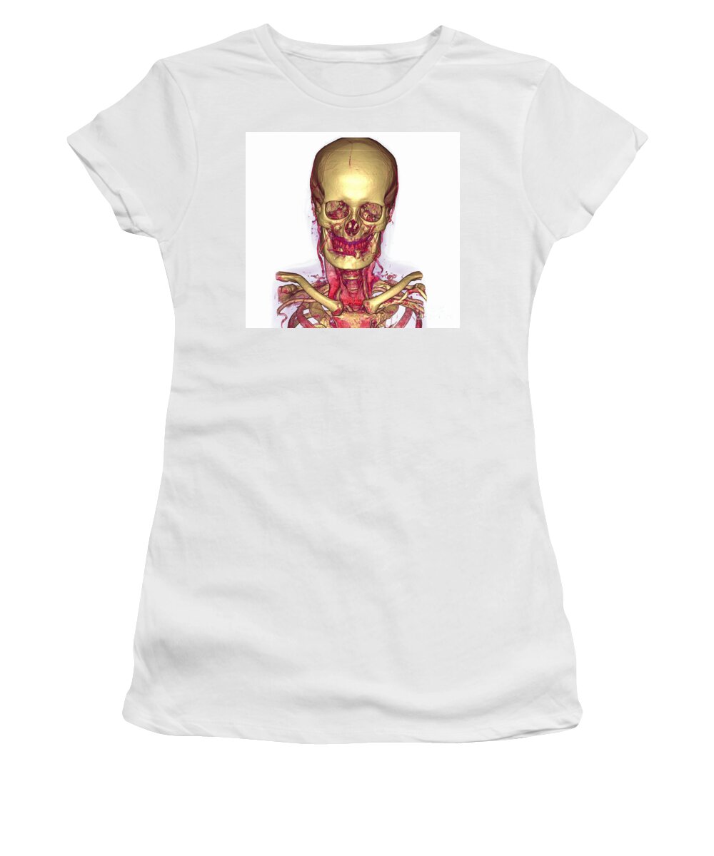 Angiography Women's T-Shirt featuring the photograph Male Skull & Arterial System #4 by Scott Camazine