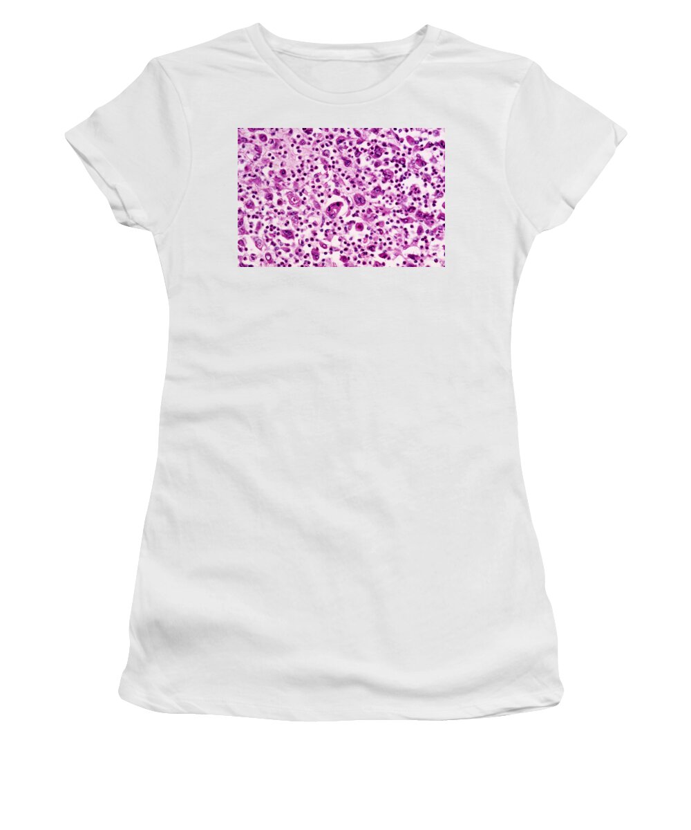 Abnormal Women's T-Shirt featuring the photograph Giant-cell Carcinoma Of The Lung, Lm by Michael Abbey