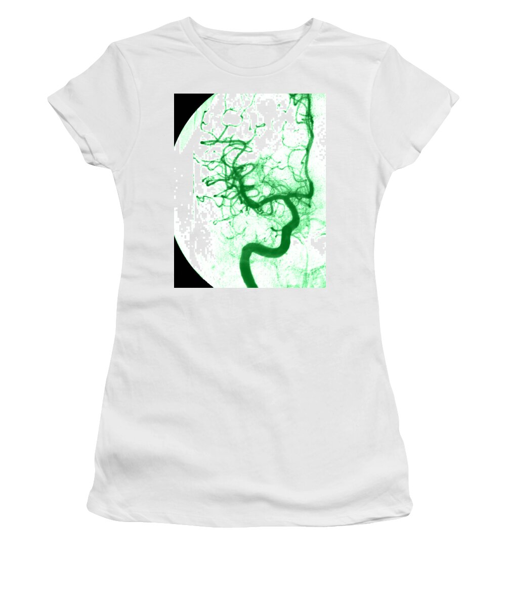 Angiogram Women's T-Shirt featuring the Cerebral Angiogram #10 by Medical Body Scans