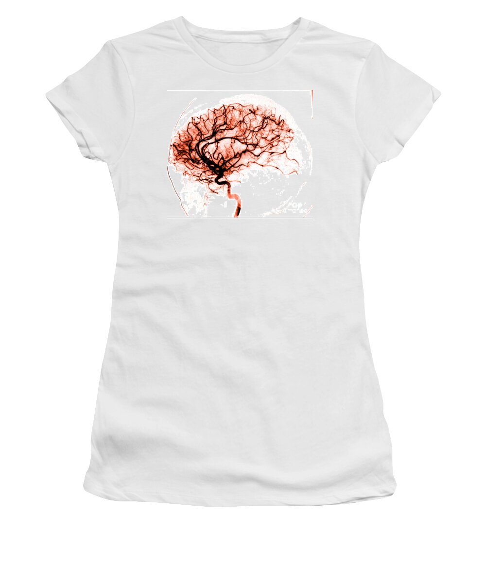 Catheter Cerebral Angiogram Women's T-Shirt featuring the photograph Cerebral Angiogram by Medical Body Scans