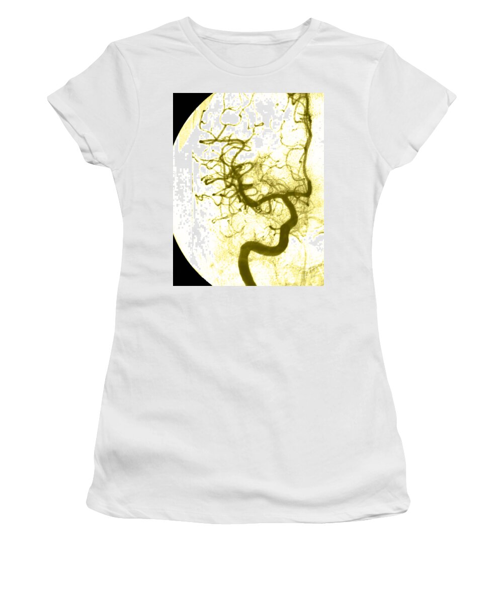 Angiogram Women's T-Shirt featuring the photograph Cerebral Angiogram #7 by Medical Body Scans