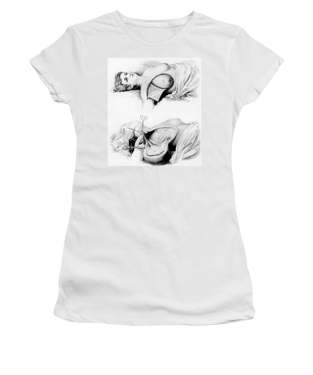 Halsted Radical Mastectomy, Incision Women's T-Shirt by Science