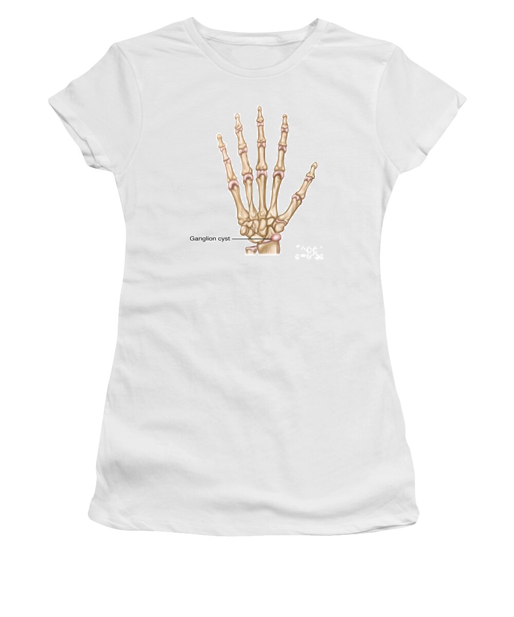 Ganglion Women's T-Shirt featuring the photograph Ganglion Cyst, Illustration #2 by Gwen Shockey