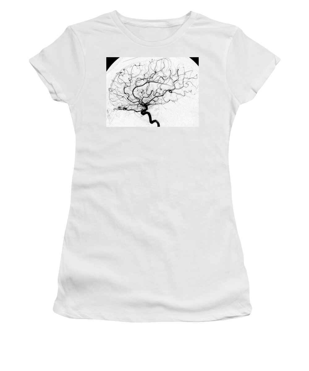 Cerebral Angiogram Women's T-Shirt featuring the photograph Dural Arterial Venous Fistula, Angiogram by Living Art Enterprises