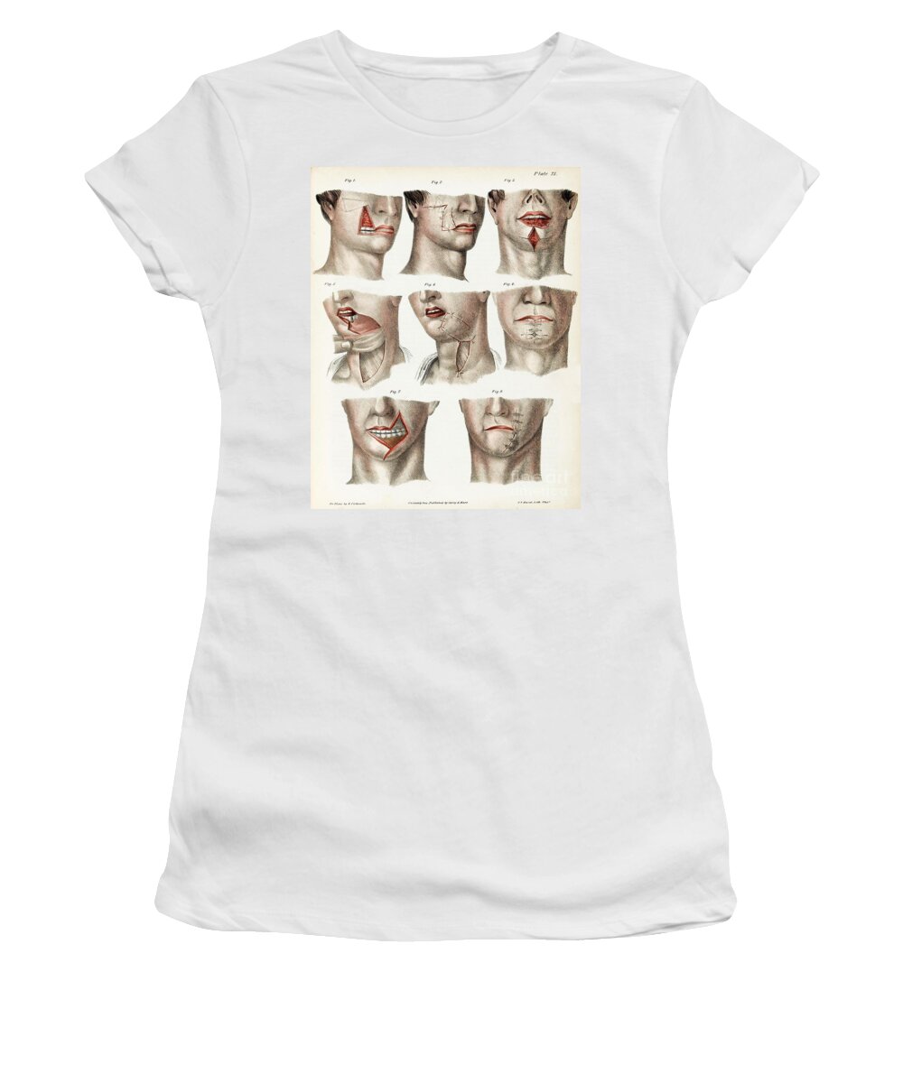 Historic Women's T-Shirt featuring the photograph Facial Surgery, Illustration, 1846 by Wellcome Images