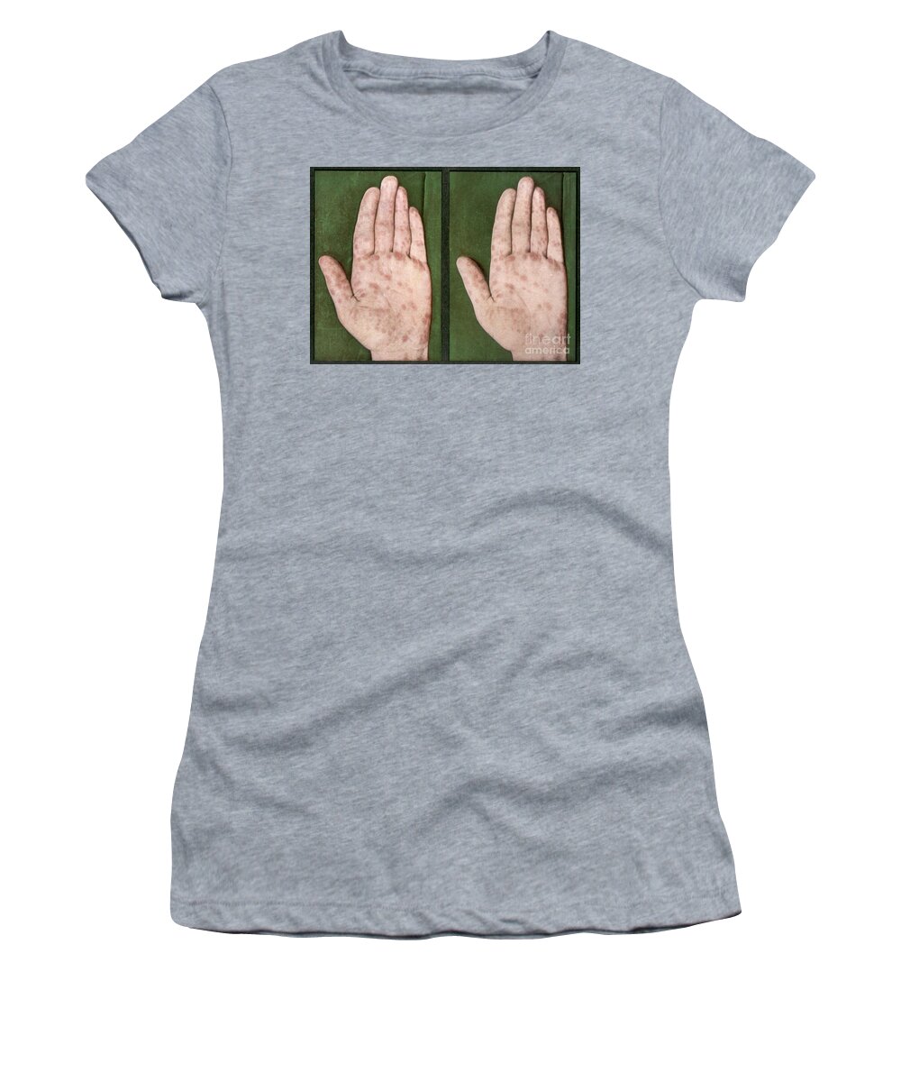 Science Women's T-Shirt featuring the photograph Rash Caused By Syphilis, Vintage by DoubleVision