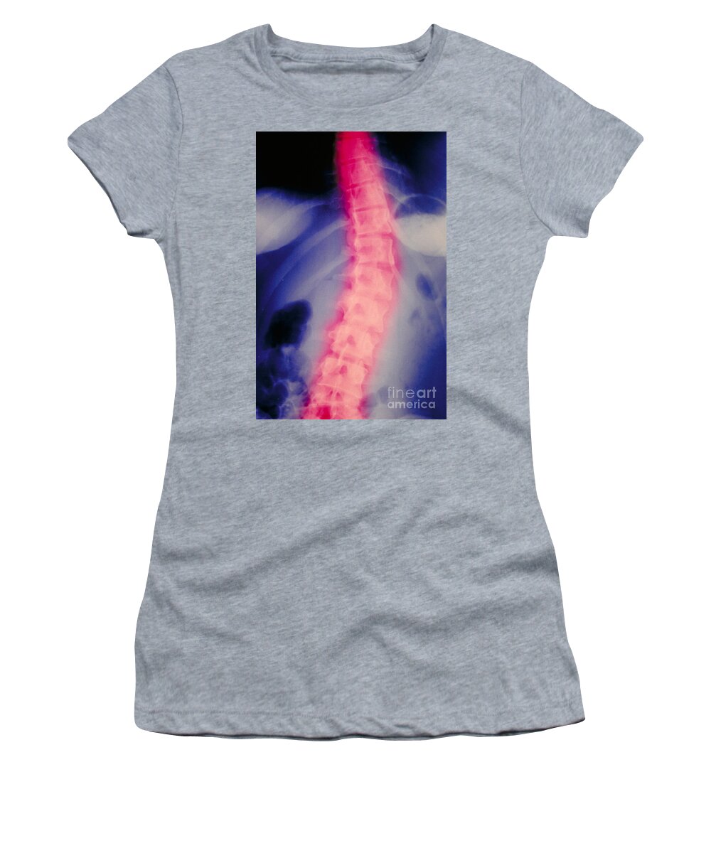 Vertical Women's T-Shirt featuring the photograph X-ray. Scoliosis Of Spine by Scott Camazine & Sue Trainor