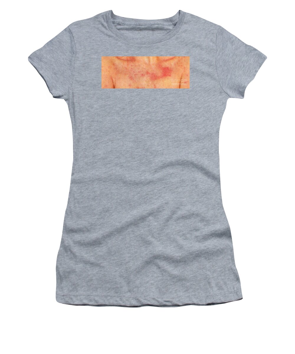 Psoriasis Chest Women's T-Shirt featuring the photograph Acute Psoriasis by Science Source