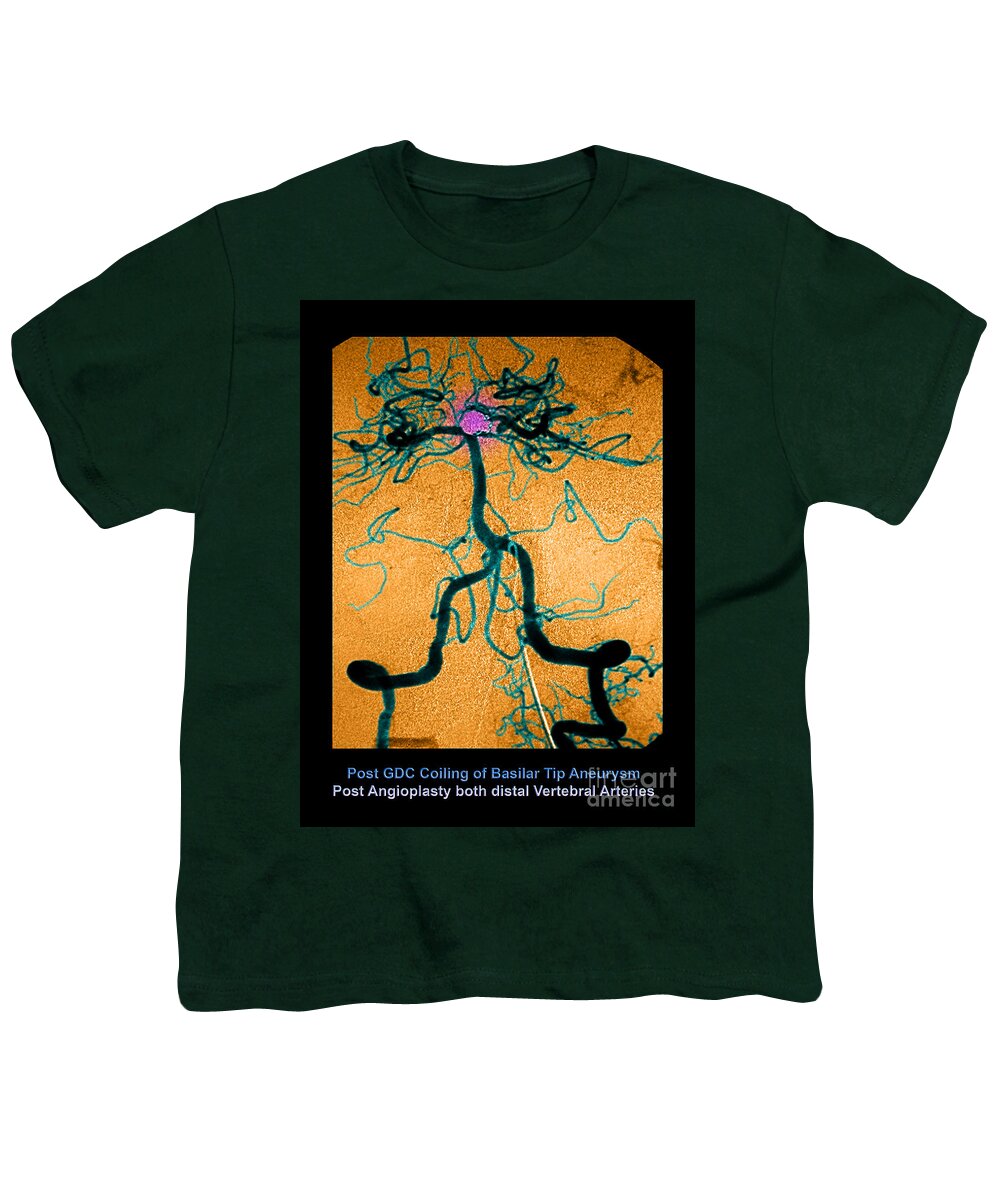 Abnormal Blood Vessel Youth T-Shirt featuring the photograph Cerebral Angiogram #6 by Medical Body Scans