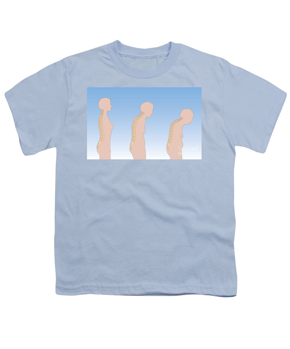 Aging Youth T-Shirt featuring the photograph Progression Of Osteoporosis by Photo Researchers, Inc.