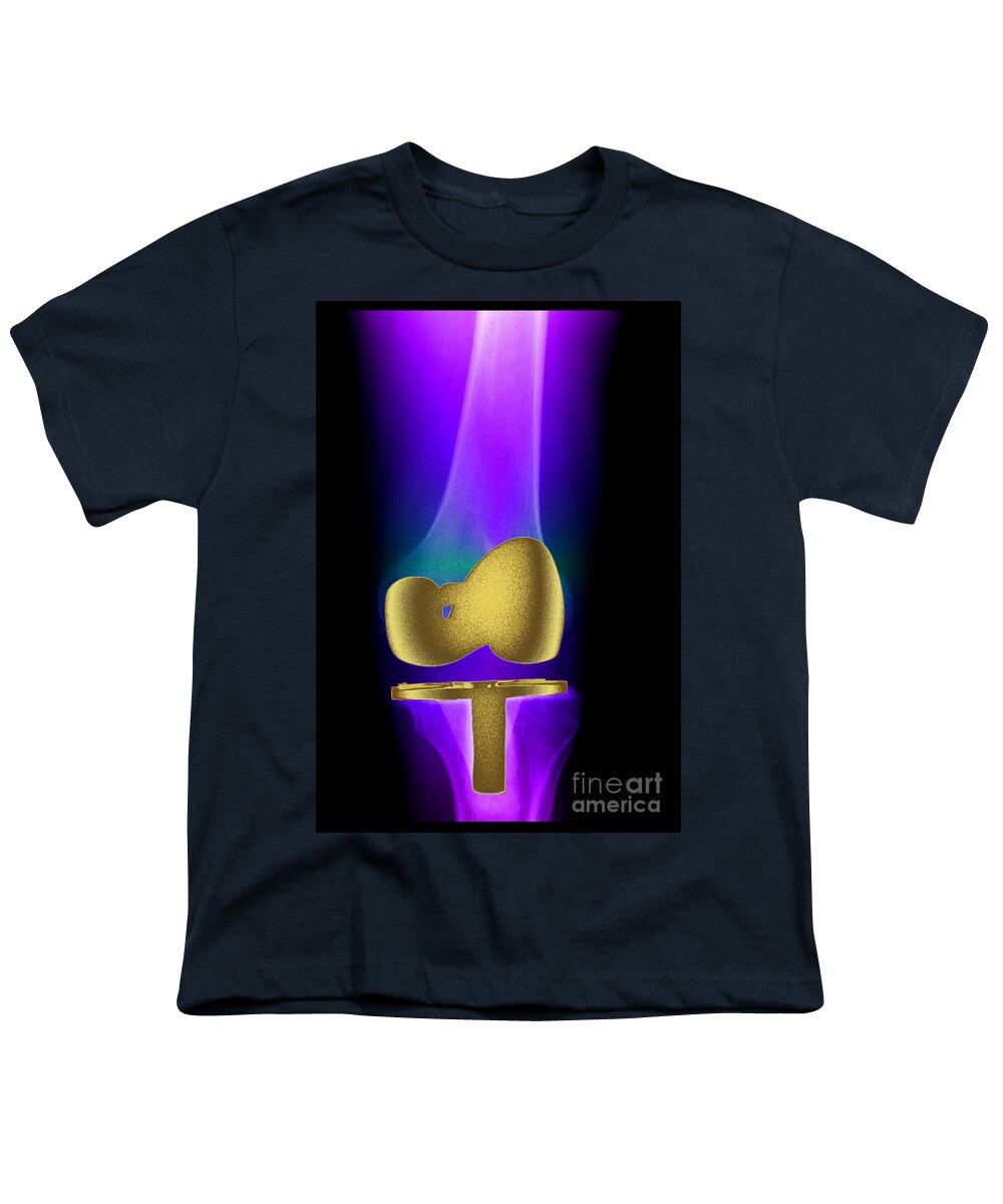 X-ray Youth T-Shirt featuring the photograph Total Knee Replacement #2 by Living Art Enterprises