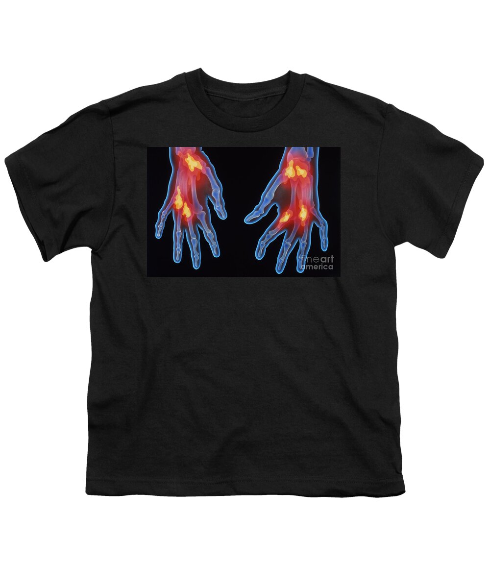 X-ray Of Arthritic Hands Youth T-Shirt featuring the photograph X-ray Of Arthritic Hands by Chris Bjornberg