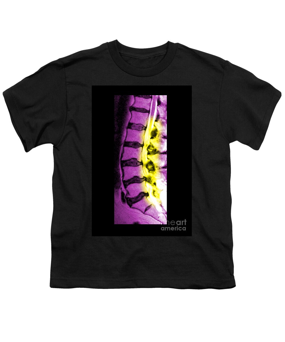 Foraminal Stenosis Youth T-Shirt featuring the photograph Severe Facet Joint Degeneration #2 by Medical Body Scans