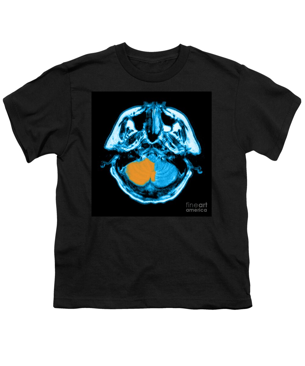 Abnormal Pica Youth T-Shirt featuring the photograph Mri Of Stroke #5 by Medical Body Scans