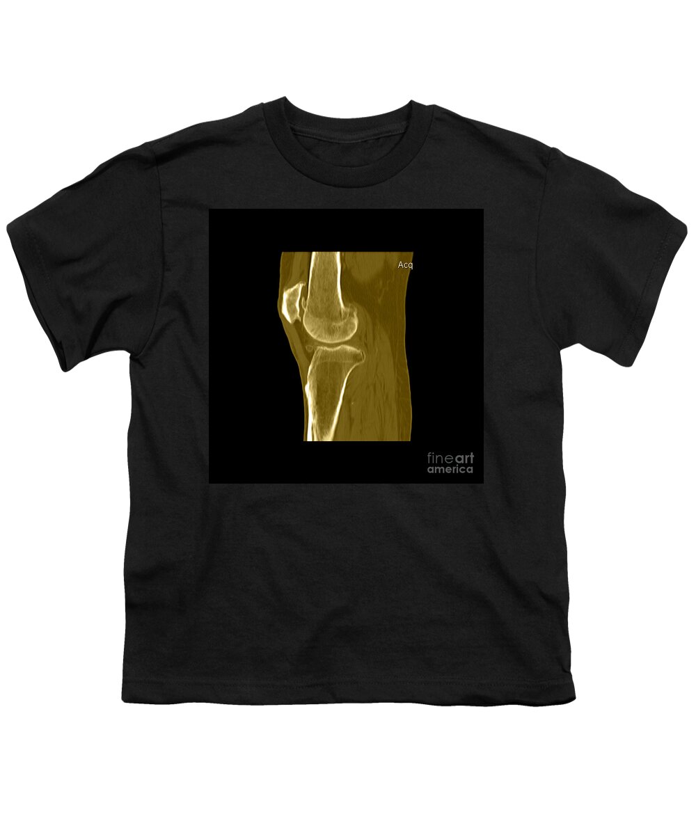 Joint Youth T-Shirt featuring the photograph Knee Showing Osteoporosis by Medical Body Scans