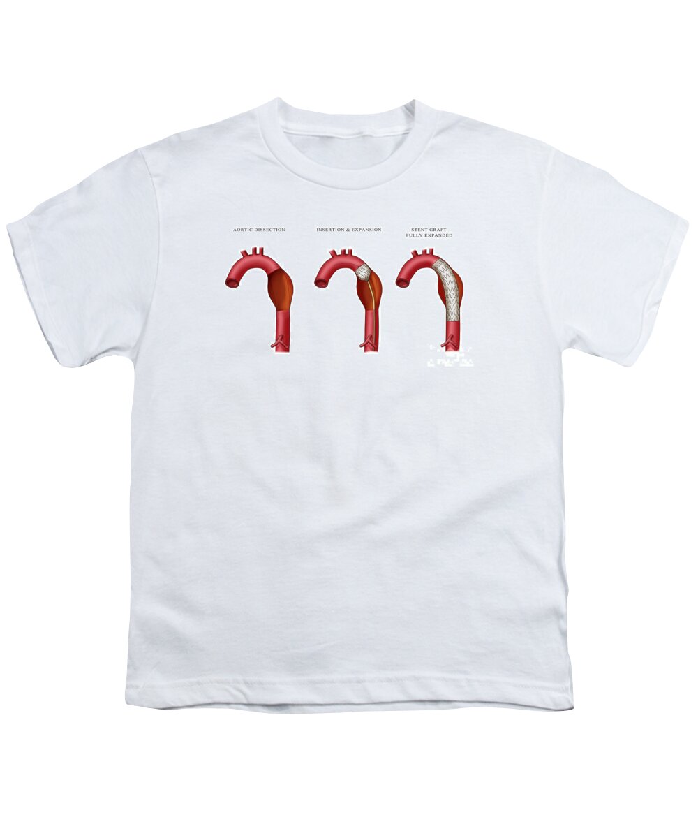 Aortic Stent Graft Youth T-Shirt featuring the photograph Aortic Aneurysm Stent, Illustration by Monica Schroeder