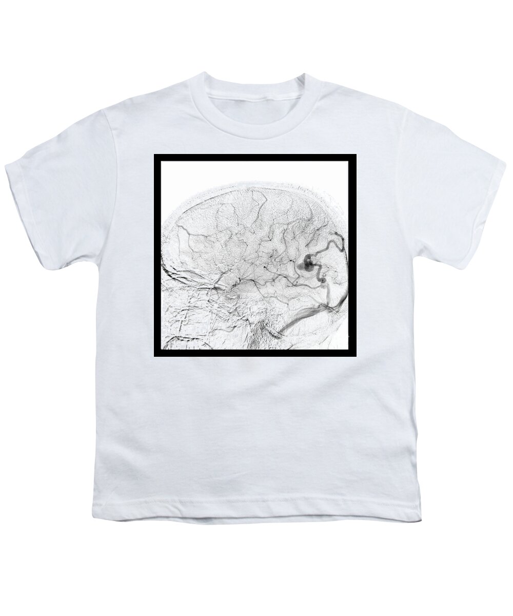 Avm Youth T-Shirt featuring the photograph Parietal Lobe Avm, Angiogram #1 by Living Art Enterprises