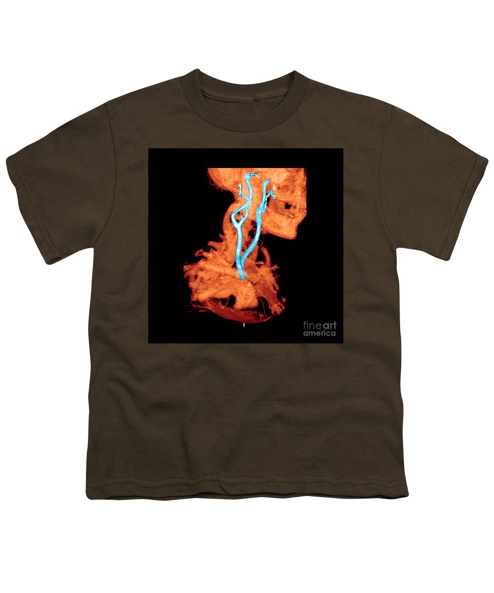 3 Dimensional Youth T-Shirt featuring the photograph 3d Cta Of Carotid Arteries #2 by Medical Body Scans