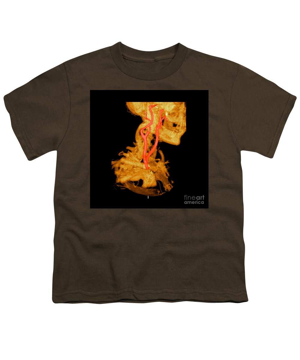3 Dimensional Youth T-Shirt featuring the photograph 3d Cta Of Carotid Arteries by Medical Body Scans