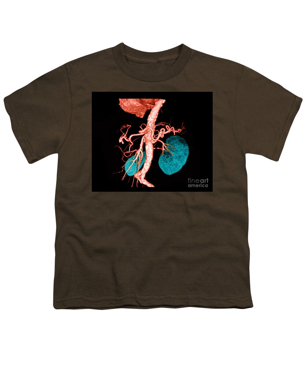 3 Dimensional Youth T-Shirt featuring the photograph Abdominal Aorta #7 by Medical Body Scans
