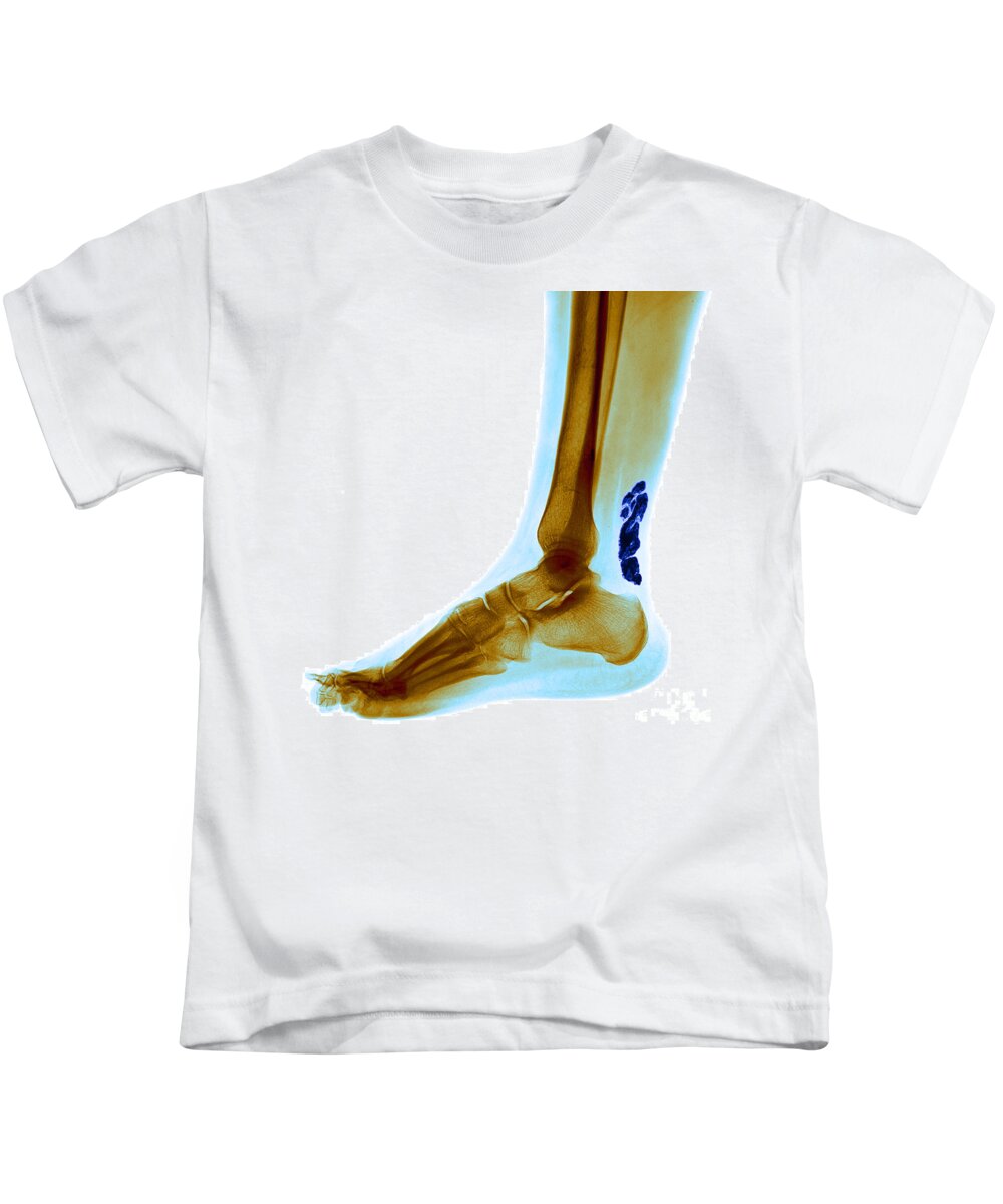 Achilles Tendinitis Kids T-Shirt featuring the photograph Achilles Tendinitis by Medical Body Scans