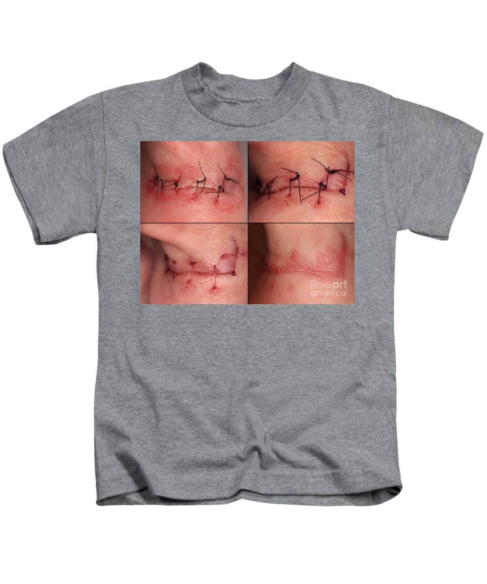 Science Kids T-Shirt featuring the photograph Wound Healing Sequence by Ted Kinsman
