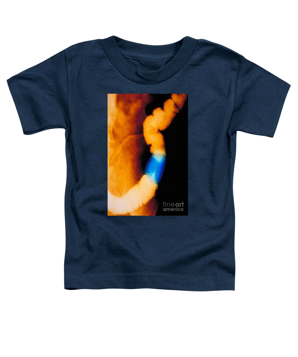 Enhanced Toddler T-Shirt featuring the photograph Abdomen X-ray Of Colon Cancer by Scott Camazine & Sue Trainor
