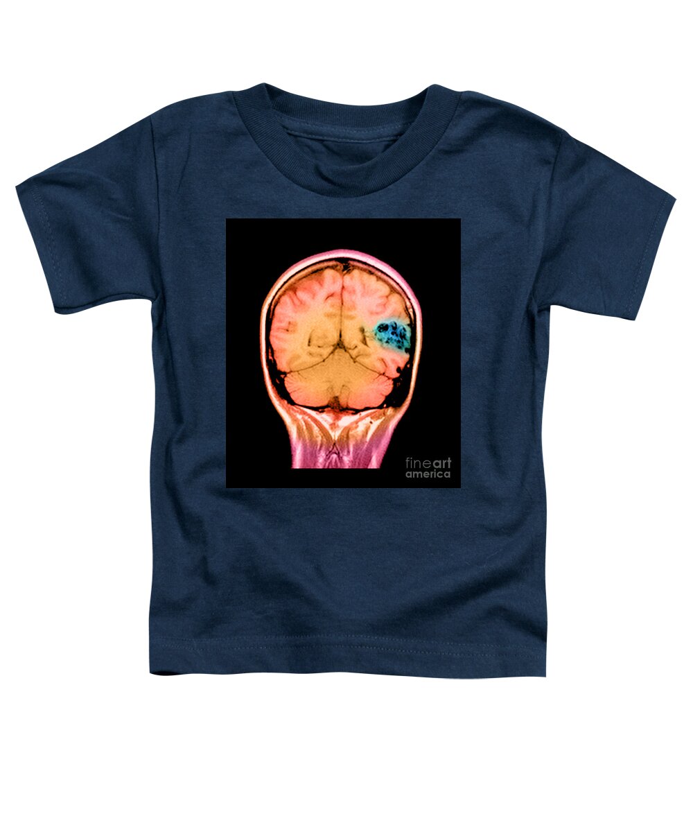 Abnormal Cerebral Blood Vessels Toddler T-Shirt featuring the photograph Mri Of Brain Avm #14 by Medical Body Scans
