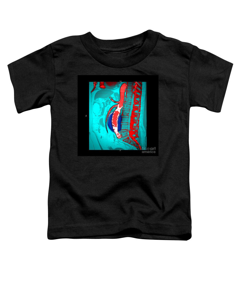 Science Toddler T-Shirt featuring the photograph Abdominal Stent Graft #1 by Living Art Enterprises