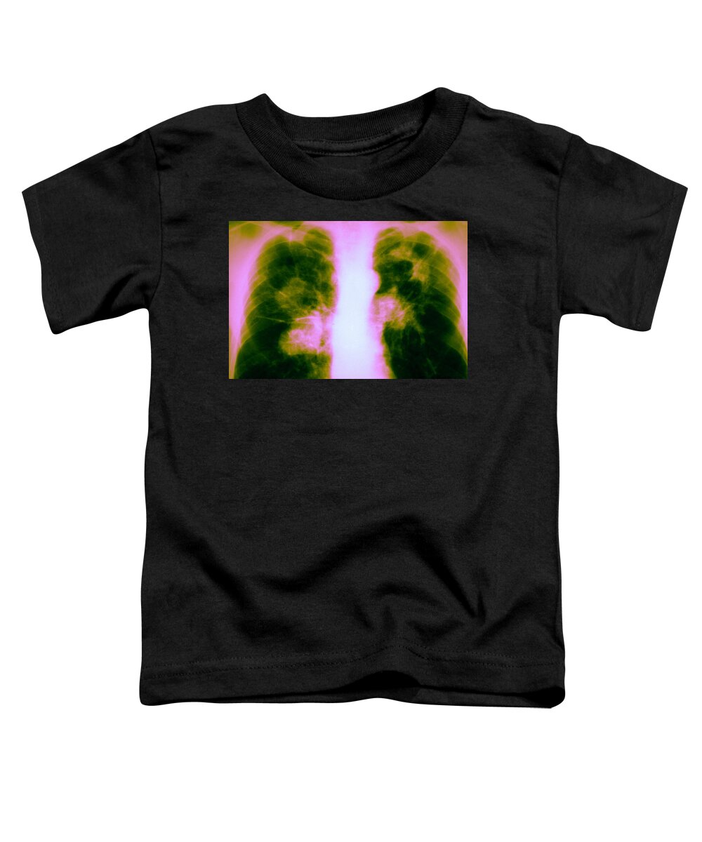 Abnormal Toddler T-Shirt featuring the photograph Tuberculosis Infection #1 by Michael Abbey