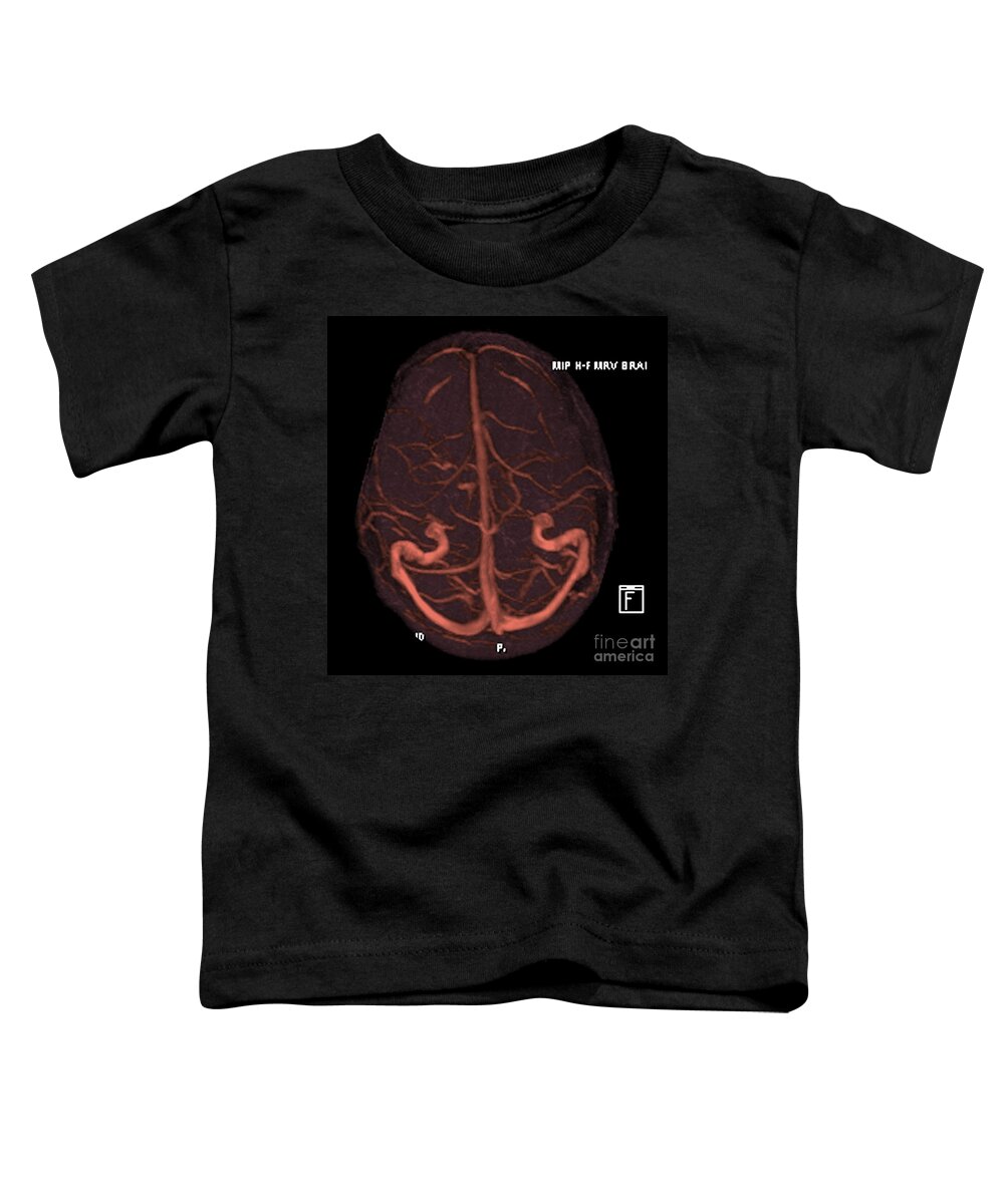 Mrv Toddler T-Shirt featuring the photograph Intracranial Magnetic Resonance Venogram #3 by Medical Body Scans