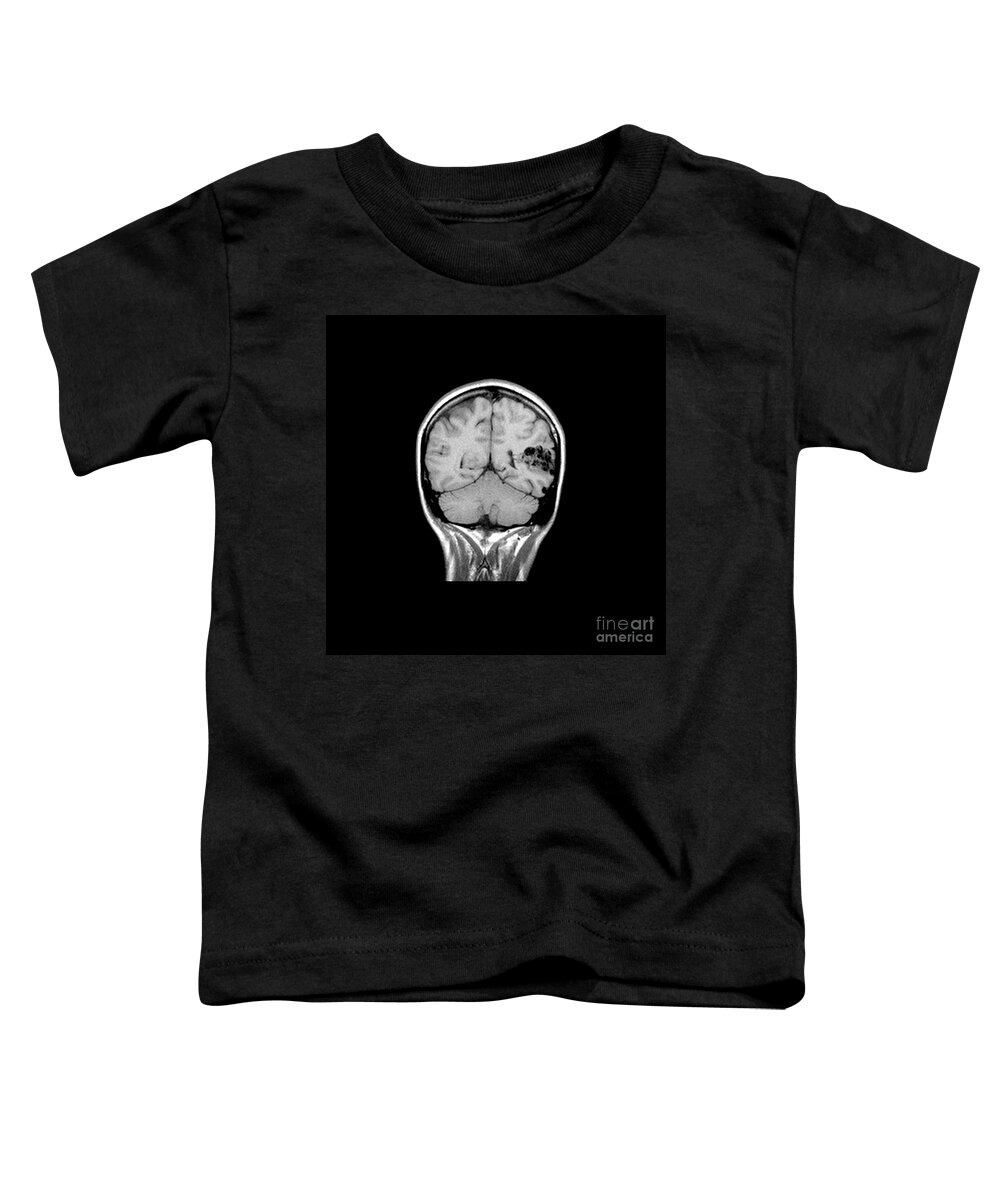 Mri Brain Toddler T-Shirt featuring the photograph Mri Of Brain Avm #9 by Medical Body Scans