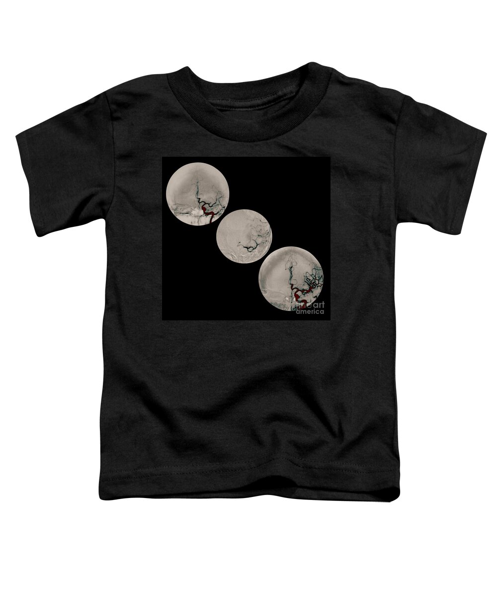 Angiogram Of Stroke Toddler T-Shirt featuring the photograph Stroke Treatment by Medical Body Scans