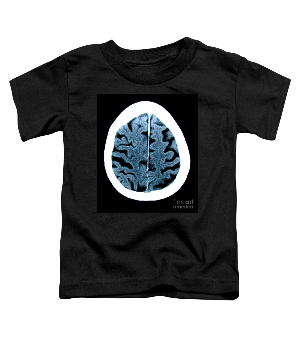 Radiology Toddler T-Shirt featuring the photograph Brain Of Alzheimers Patient, Ct Scan #1 by Scott Camazine