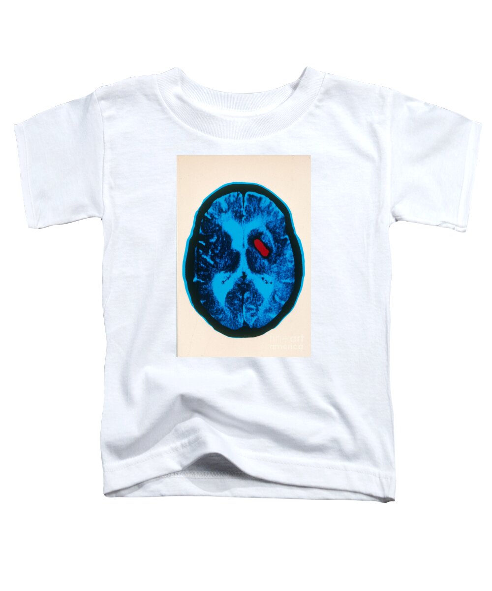 Ct Scan Toddler T-Shirt featuring the photograph Hemorrhagic Stroke, Ct Scan by Scott Camazine