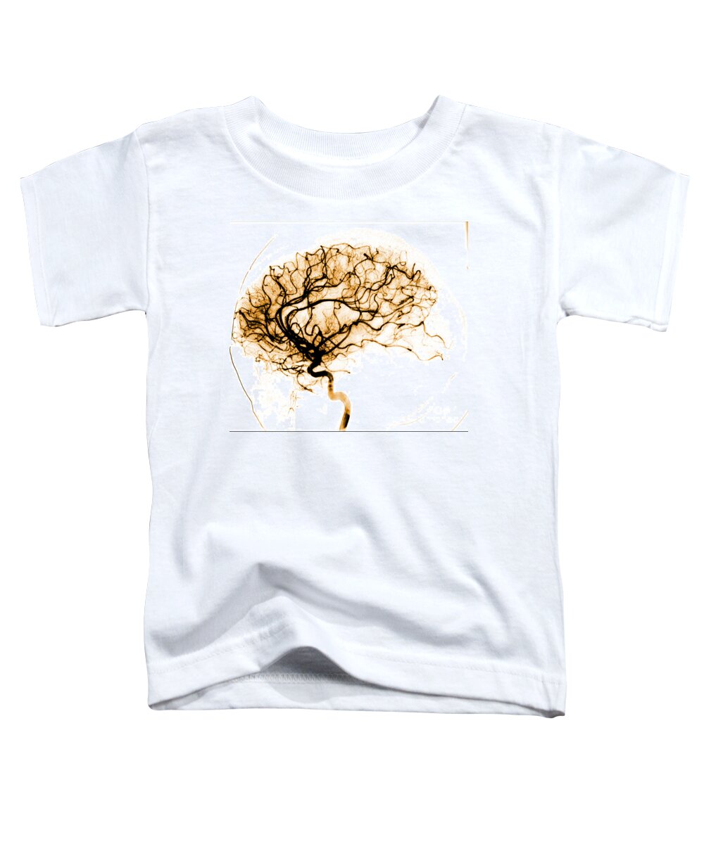 Catheter Cerebral Angiogram Toddler T-Shirt featuring the photograph Cerebral Angiogram #4 by Medical Body Scans