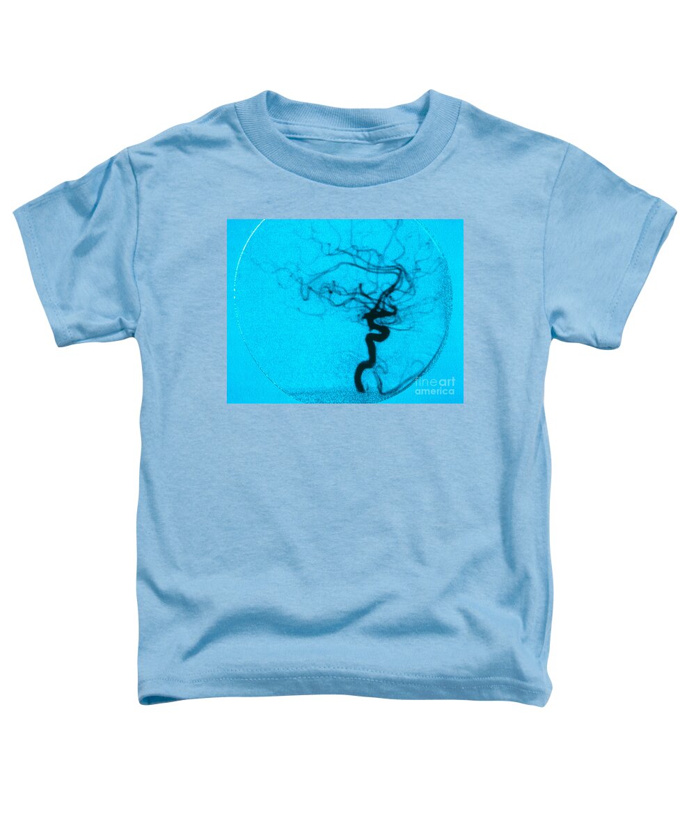 Angiogram Toddler T-Shirt featuring the photograph Cerebral Angiogram by Science Source