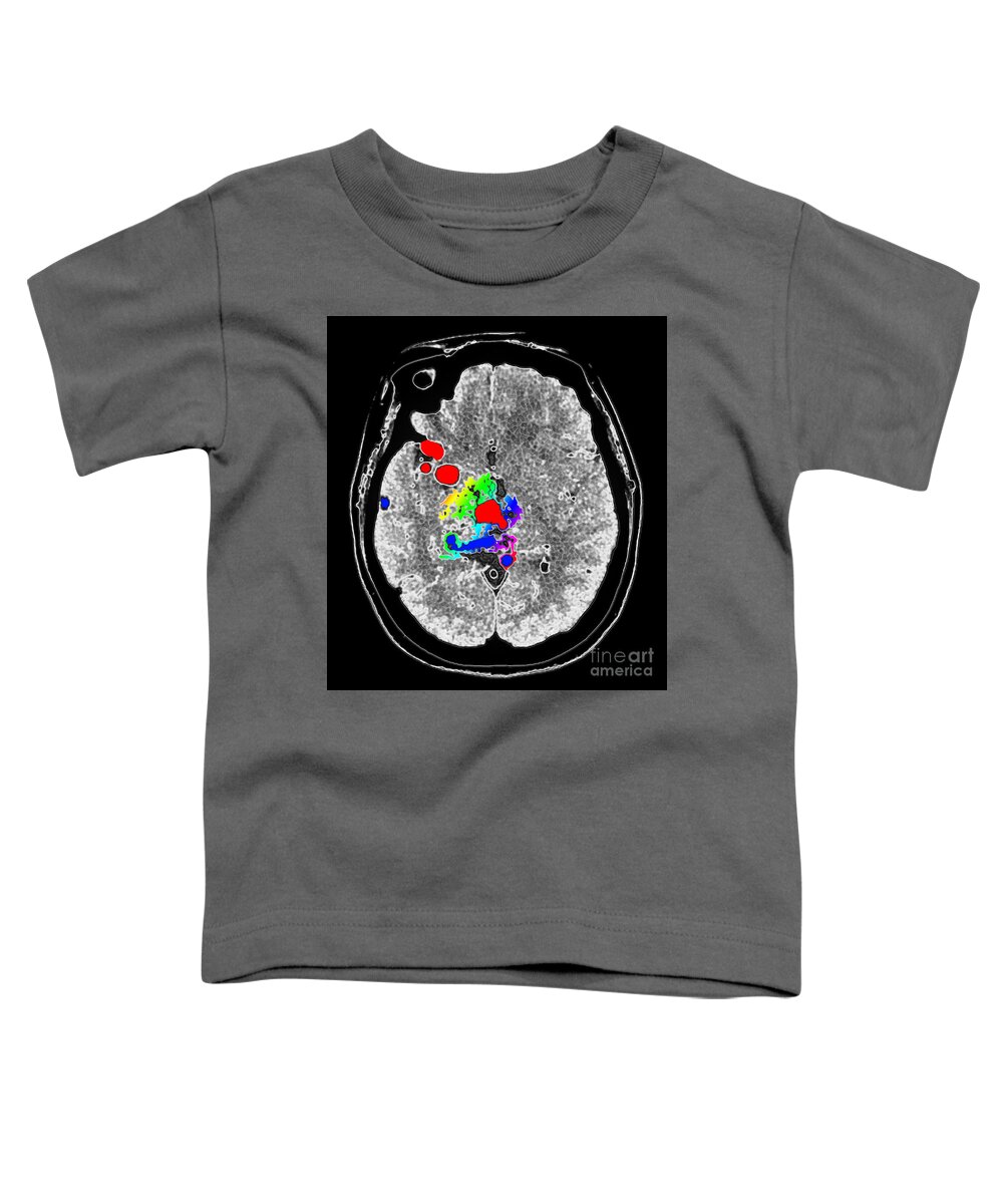 Avm Toddler T-Shirt featuring the photograph Enhanced Deep Brain Avm 6 by Living Art Enterprises, LLC