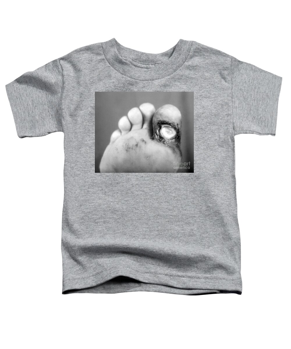 Bacterial Toddler T-Shirt featuring the photograph Syphilis Ulcer by Science Source