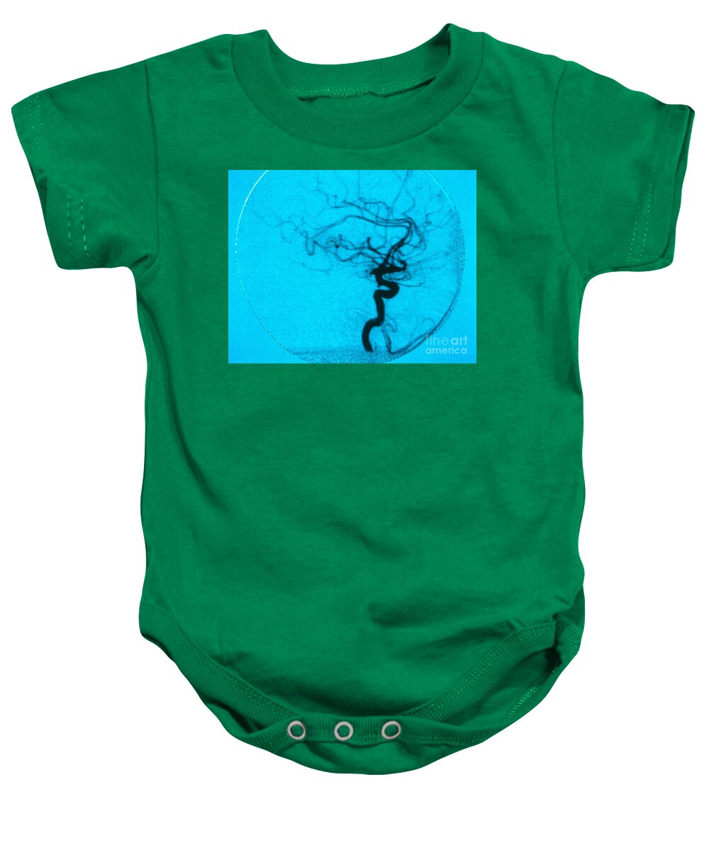 Angiogram Baby Onesie featuring the photograph Cerebral Angiogram by Science Source