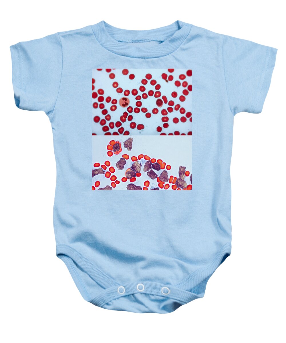 Blood Cell Baby Onesie featuring the photograph Healthy Leukemia Blood Comparison by Spencer Sutton